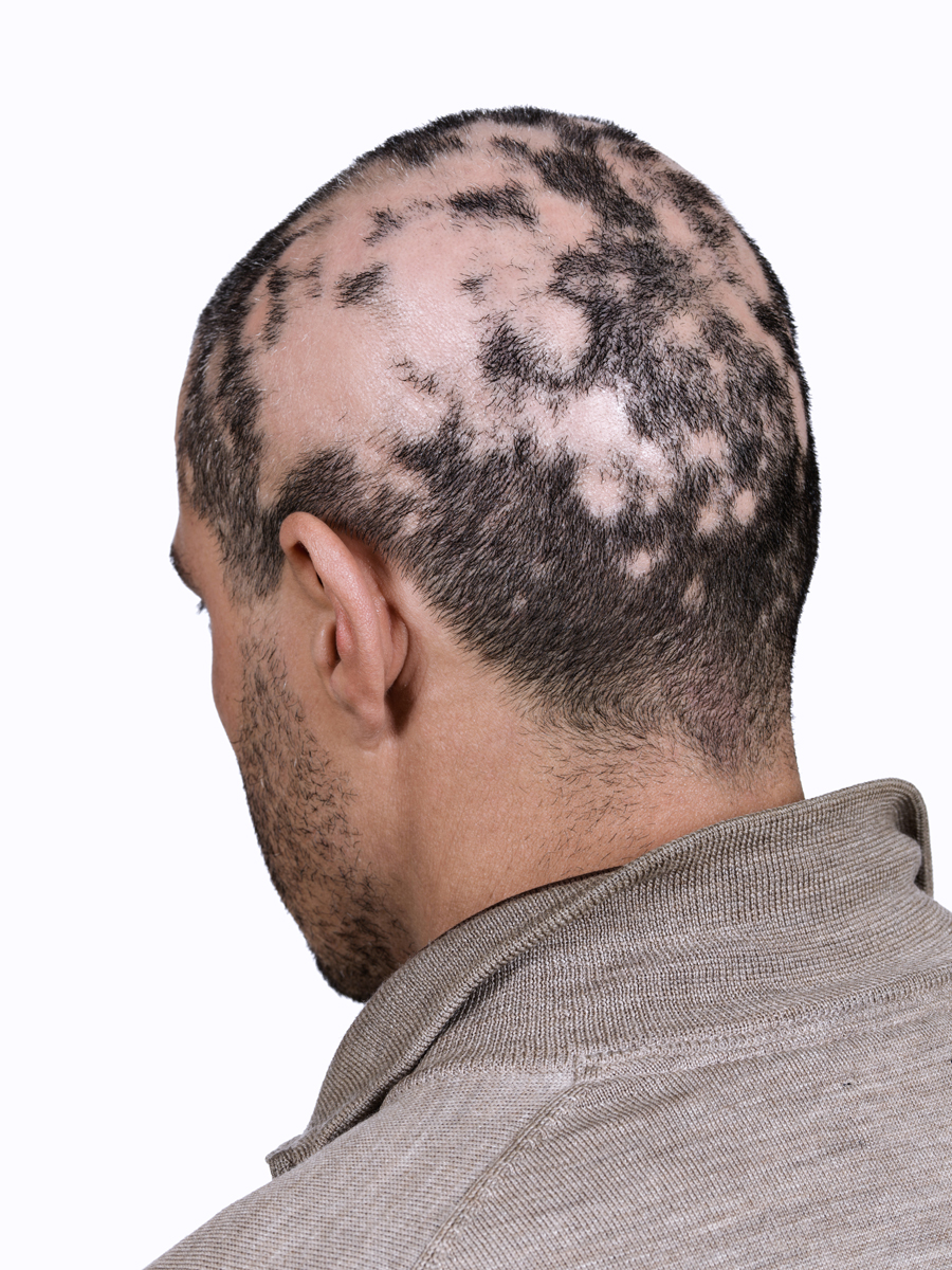 hair-loss-in-men-causes-and-prevention-tips-obro