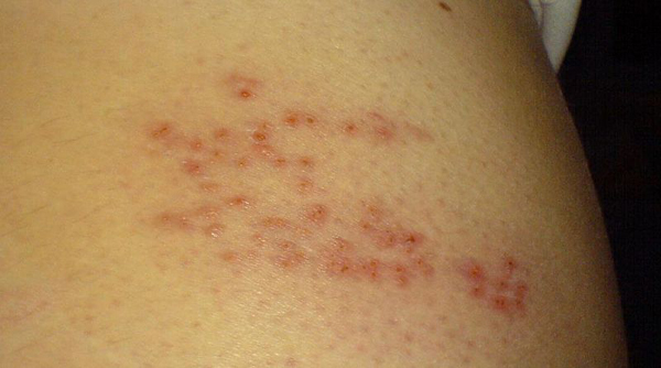 Lyme Disease And Shingles Daniel Cameron Md Mph