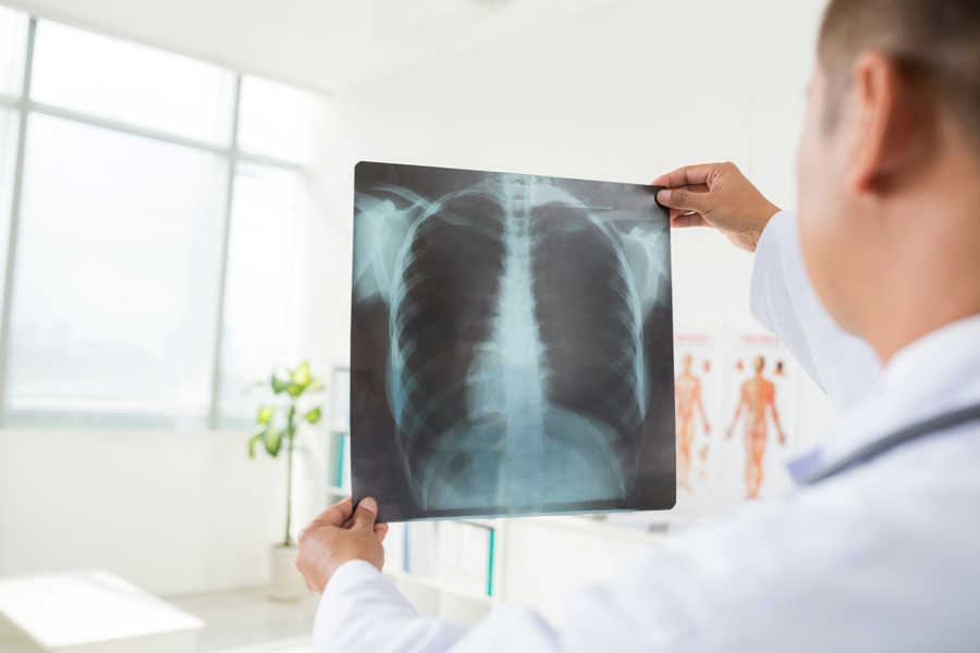 examing lung x-ray of man with sarcoidosis and Lyme disease