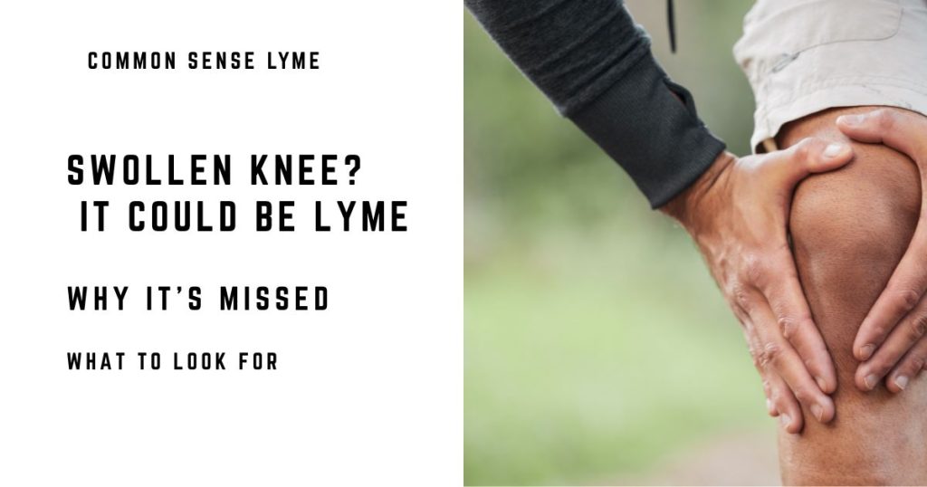 SWOLLEN KNEE THINK LYMEBITTEN BY A TICK
