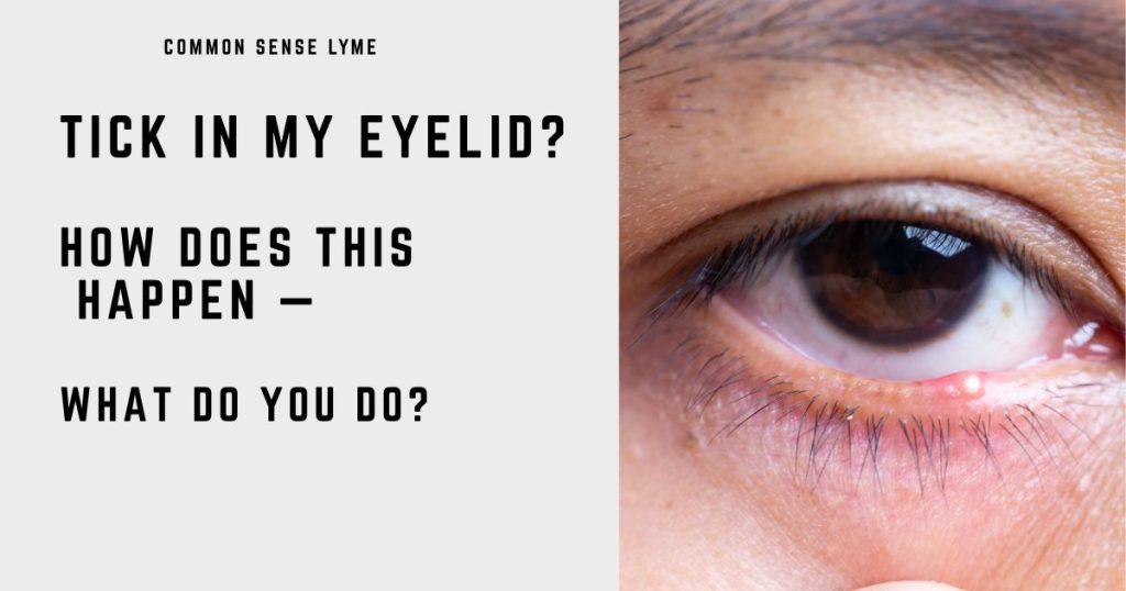 TICK IN MY EYELID
