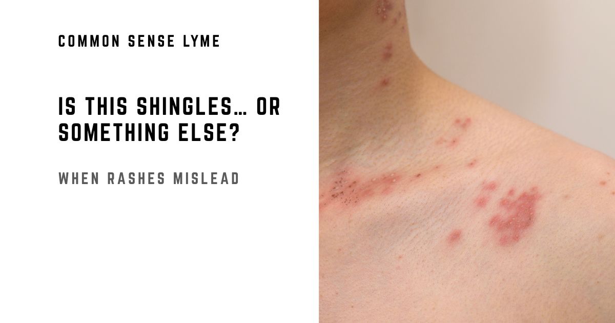 Lyme Disease Mistaken for Shingles: Case Report and Key Differences