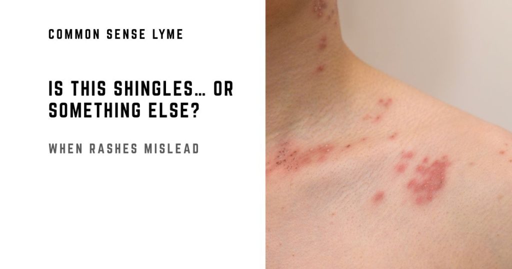 IS THIS SHINGLES… OR SOMETHING ELSE