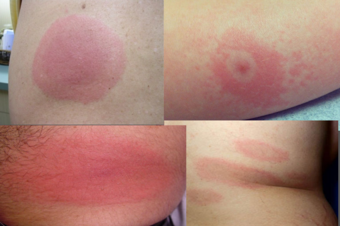 photos of what does a Lyme disease rash look like look-like