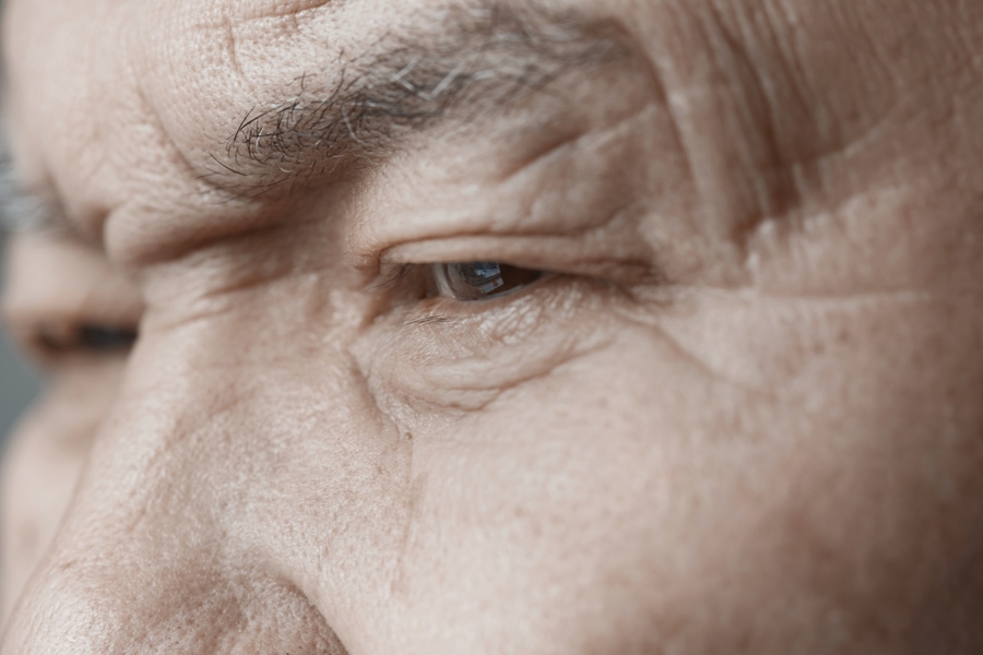 facial palsy from lyme disease in elderly man