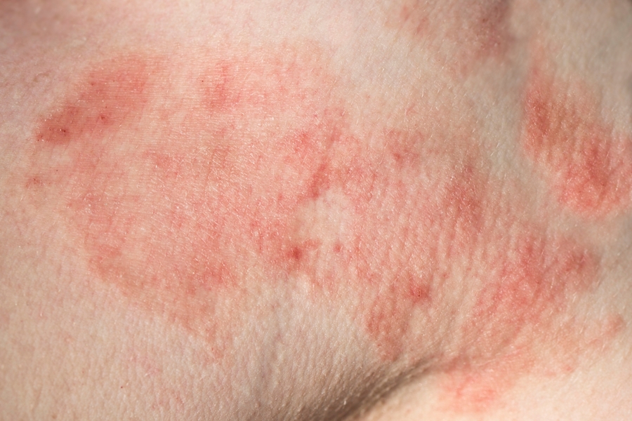 lyme-disease-tick-bite-rash