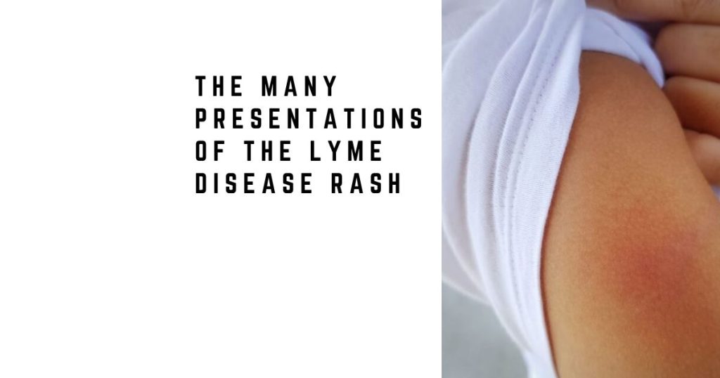 The Many Presentations of the Lyme Disease Rash