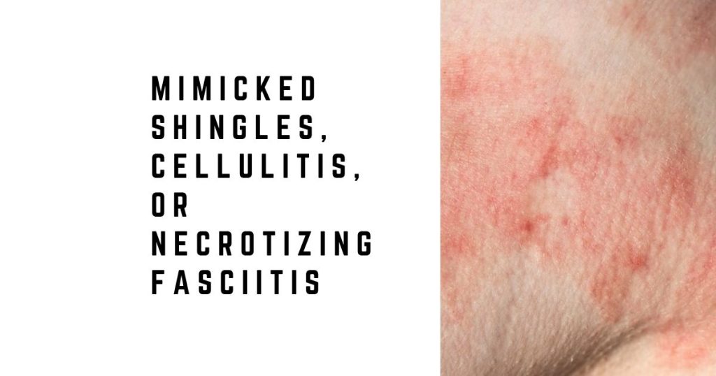 Mimicked shingles, cellulitis, or necrotizing fasciitis