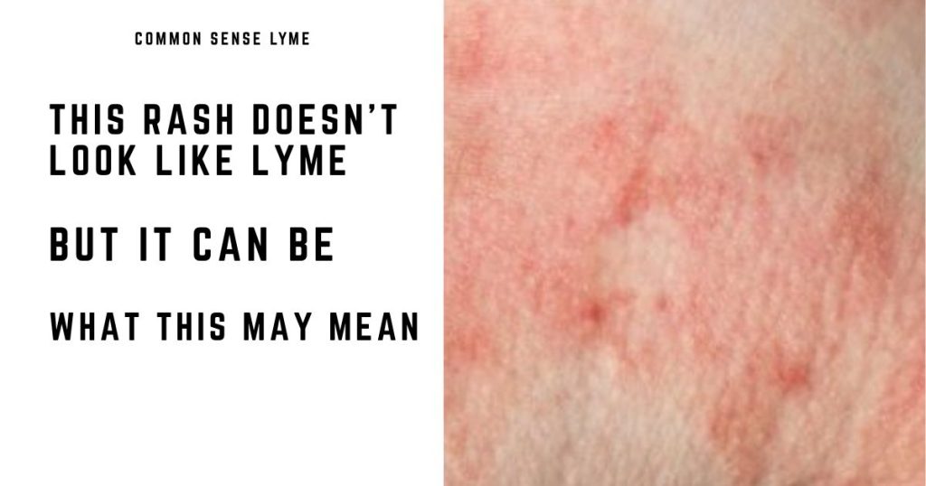 THIS RASH DOESN’T LOOK LIKE LYME
