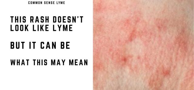 THIS RASH DOESN’T LOOK LIKE LYME