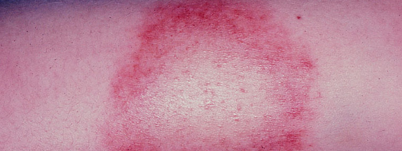 Lyme disease rash