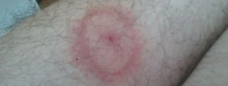 Lyme disease rash