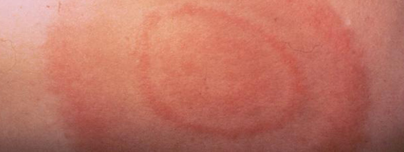 Lyme disease rash