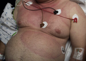 Over the course of a month, the patient’s rash grew to cover most of his chest.