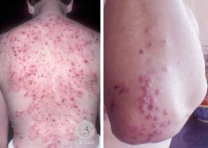 Photo of Lyme disease rash that appears to be herpes lesions.