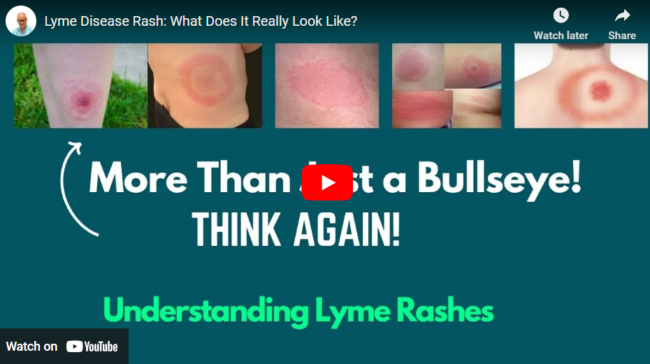 lyme-disease-rash