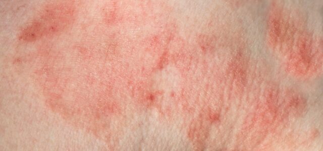 Patient with Lyme disease skin rash