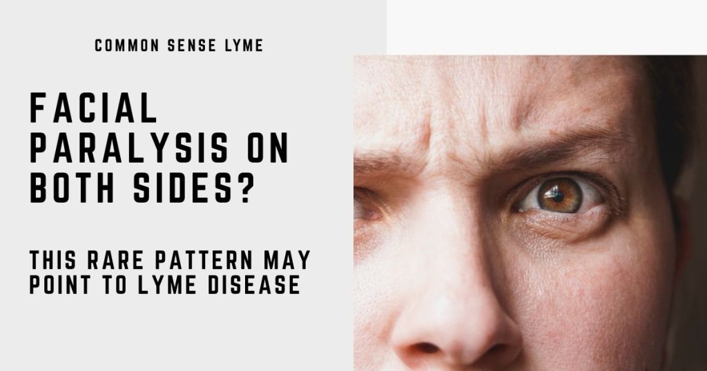 ACIAL PARALYSIS ON BOTH SIDES
