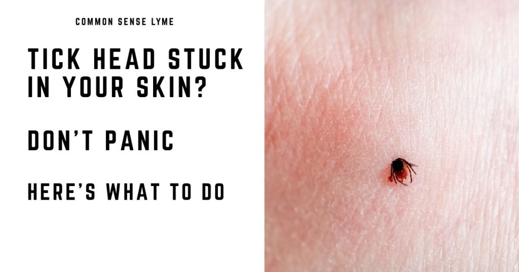 TICK HEAD STUCK IN YOUR SKIN