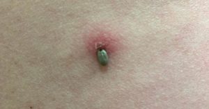 Why Doctors Disagree on Antibiotics After a Tick Bite