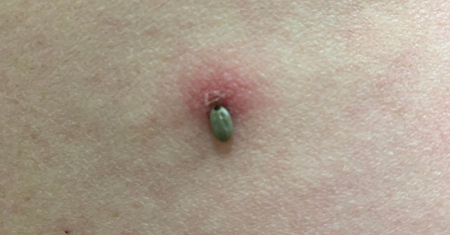 Why Doctors Disagree on Antibiotics After a Tick Bite