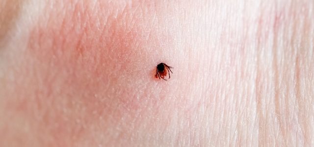 Lyme Rash Misdiagnosis: Not Every Rash Is a Bull’s-Eye