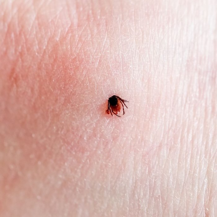Lyme Rash Misdiagnosis: Not Every Rash Is a Bull’s-Eye