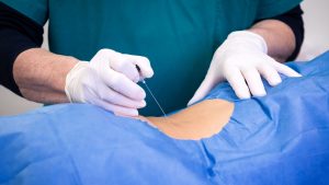 Spinal Taps for Lyme Disease: Do You Really Need One?