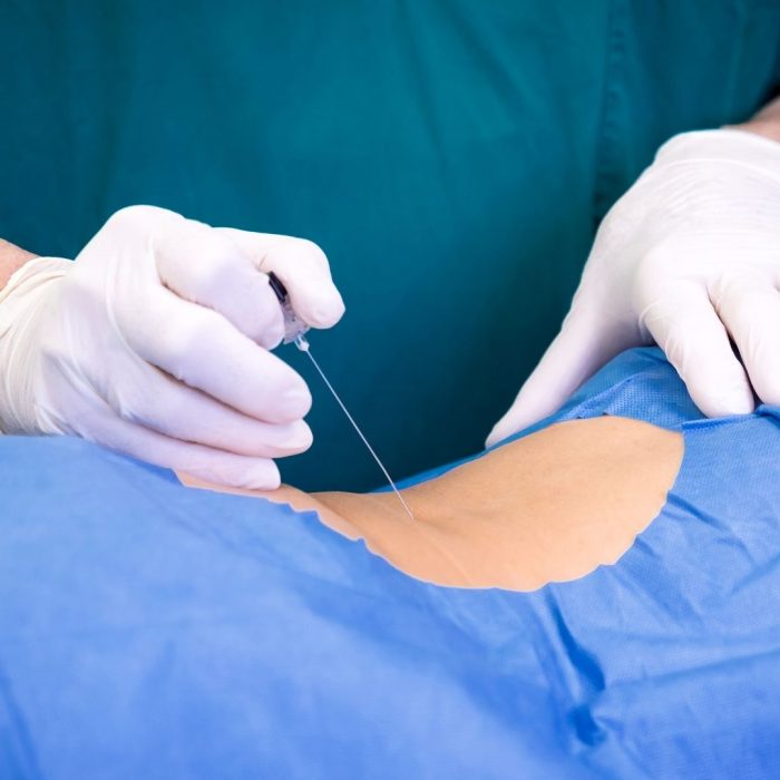 Spinal Taps for Lyme Disease: Do You Really Need One?