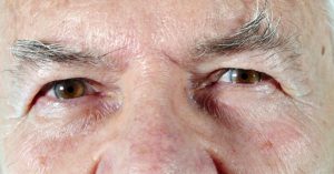 Is It Dementia—Or Just Lyme Disease?