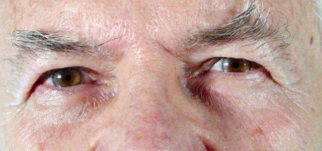 Is It Dementia—Or Just Lyme Disease?