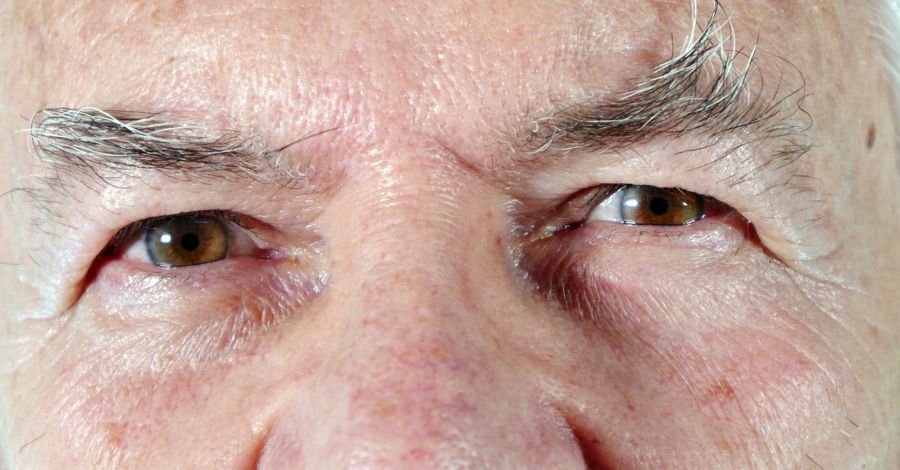 Is It Dementia—Or Just Lyme Disease?