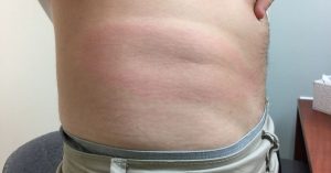 Why Most Lyme Bites Go Unnoticed