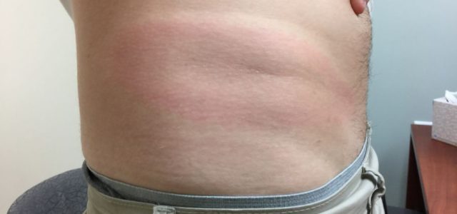 Why Most Lyme Bites Go Unnoticed