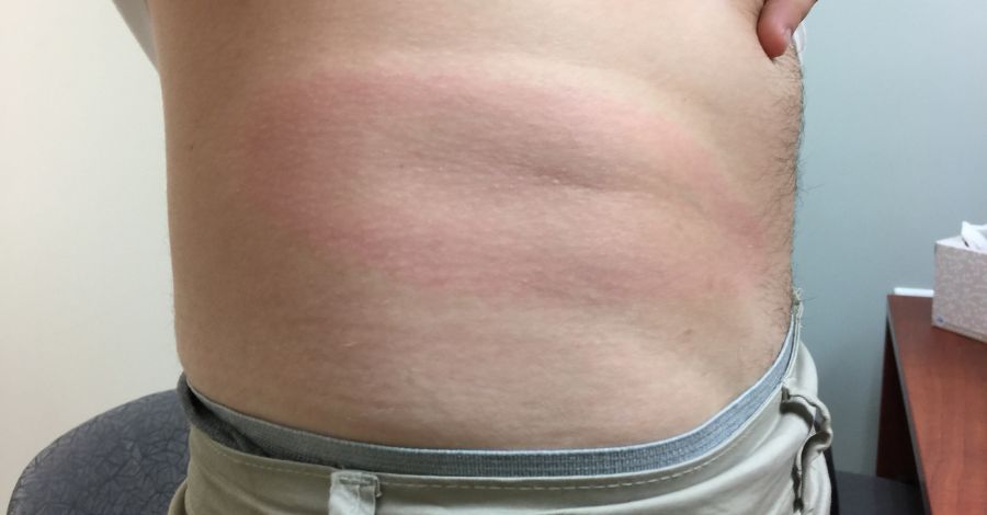 Why Most Lyme Bites Go Unnoticed