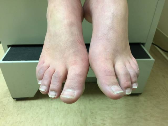 Why Extremities Become Cold, Mottled, or Discolored in Lyme Disease