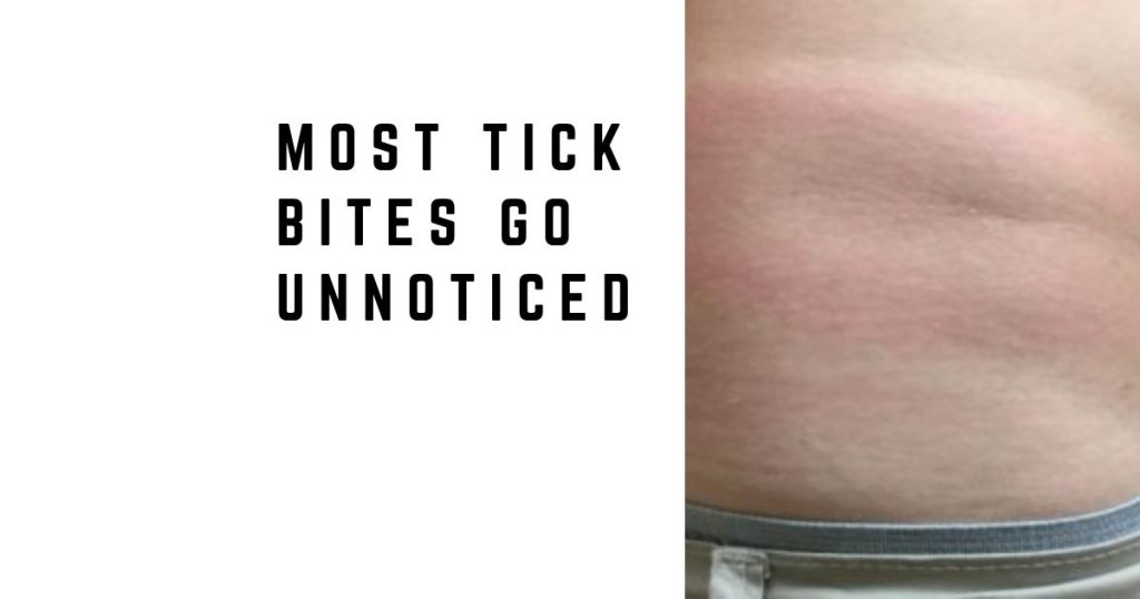 Most Tick Bites Go Unnoticed