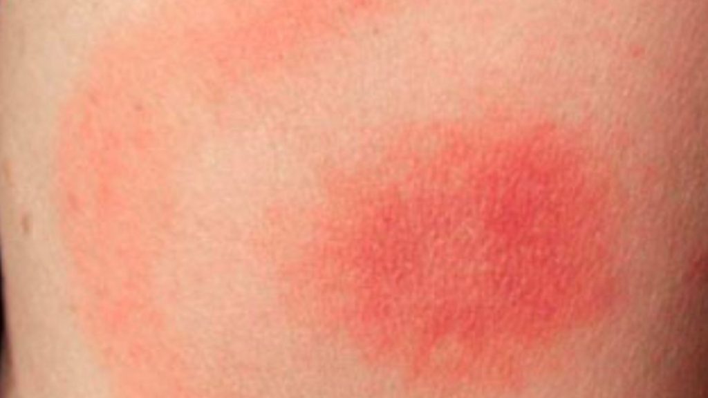 Skin Symptoms of Lyme Disease