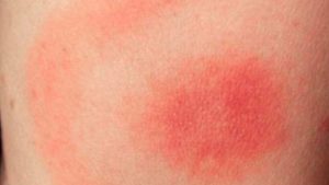 Lyme Disease Rash in Children: